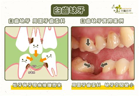 牙齒拔掉|臼齒拔掉怎麼辦？五分鐘搞懂拔牙原因、流程、術後保。